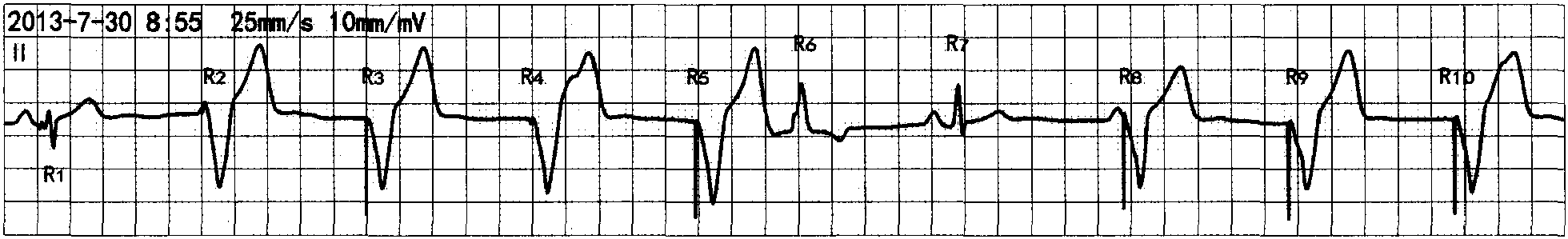 一、起搏脉冲信号的心电图特征